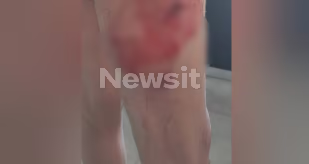 Αμέτρητες καταγγελίες για τον σκύλο της οικογένειας του Τσιτσιπά: «Η κηδεμόνας δεν ήρθε να με βοηθήσει», λέει το θύμα